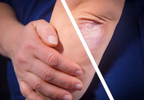 Bauskas slimnīca aicina uz praktisko semināru “Psoriāze šodien”